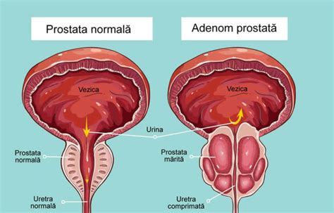 prostată și adenom